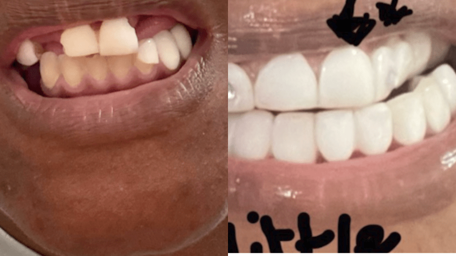 Veneers gone wrong: Woman says she's left in pain